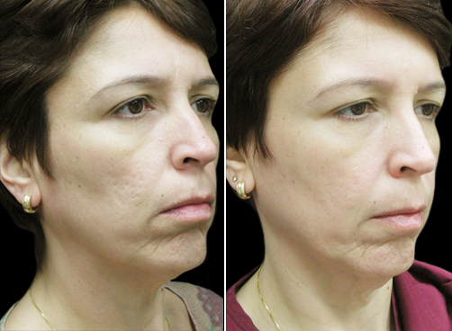 Laser Necklift Treatment Before And After