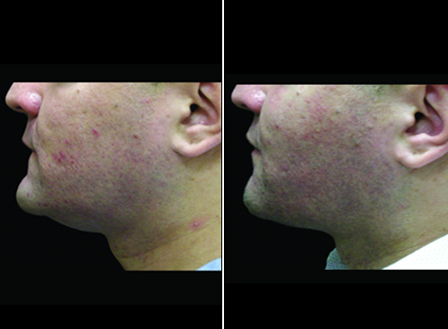 Neck Liposuction Before And After