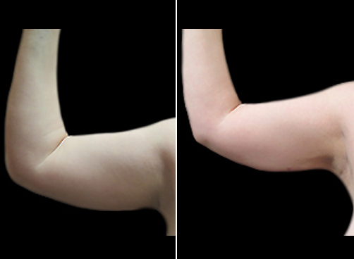 Arm Liposuction Before And After