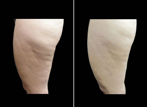Liposuction And Cellulaze Before And After