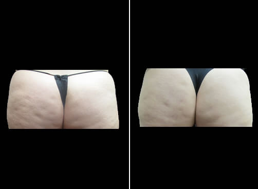 Lipo And Cellulaze Results