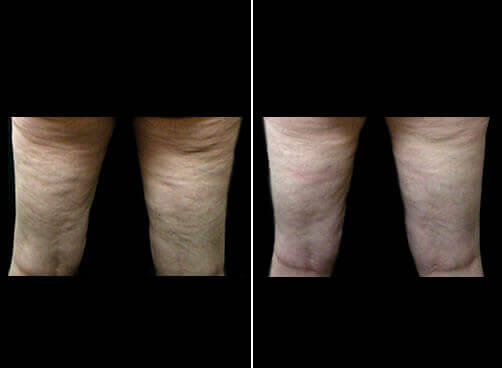 Lipo And Cellulaze Before And After