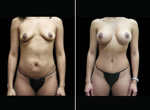 Liposuction And Mommy Makeover Results