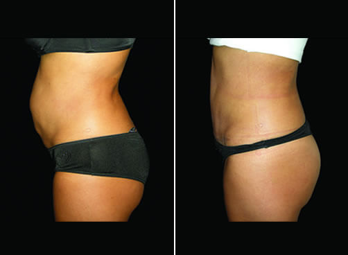 Lipo And Mommy Makeover Before And After Left Side View