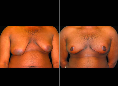 Male Breast Lipo Before And After Front Image
