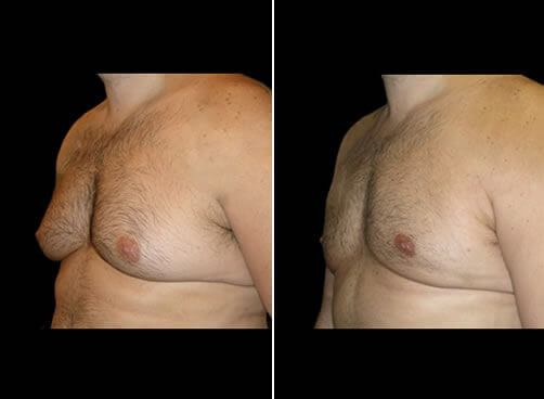 Gynecomastia Before And After Quarter View