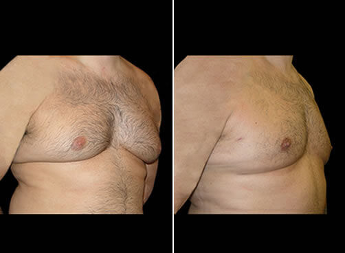 Gynecomastia Before And After