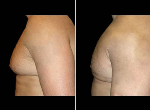 Gynecomastia Before And After Side View