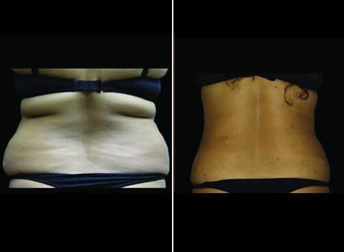 Super Wet Liposuction Before And After Back View