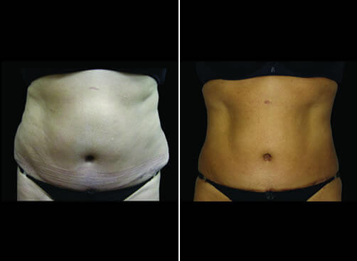 Super Wet Liposuction Before And After Front View