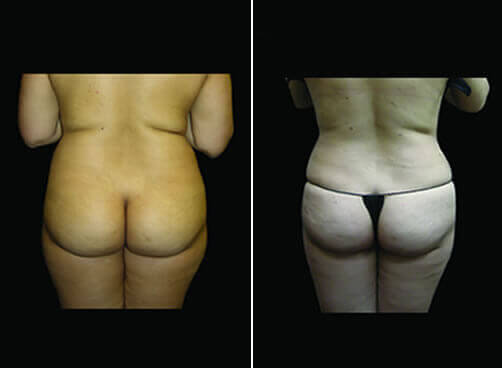 Super Wet Liposuction Before And After