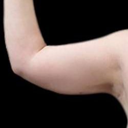 Arm Liposuction Before & After Patient #622