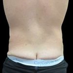 Super Wet Liposuction Before & After Patient #1367