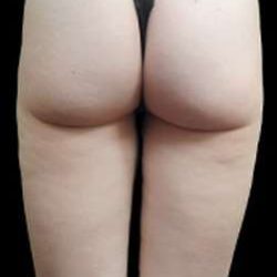 Super Wet Liposuction Before & After Patient #1372