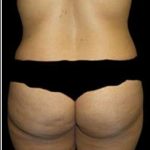 Super Wet Liposuction Before & After Patient #1389