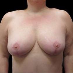 Liposuction and Breast Reduction Before & After Patient #712