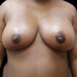 Liposuction and Breast Reduction Before & After Patient #726