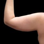 Arm Liposuction Before & After Patient #613