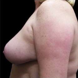 Liposuction and Breast Reduction Before & After Patient #743