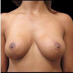 Liposuction and Breast Reduction Before & After Patient #750