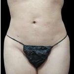 Laser Liposuction and Cellulaze Before & After Patient #759