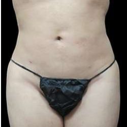 Laser Liposuction and Cellulaze Before & After Patient #759