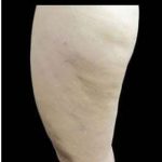 Laser Liposuction and Cellulaze Before & After Patient #762