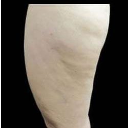 Laser Liposuction and Cellulaze Before & After Patient #762