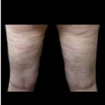 Laser Liposuction and Cellulaze Before & After Patient #768