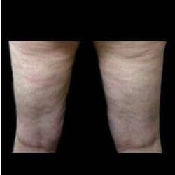 Laser Liposuction and Cellulaze Before & After Patient #768