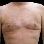 Liposuction and Gynecomastia Before & After Patient #775