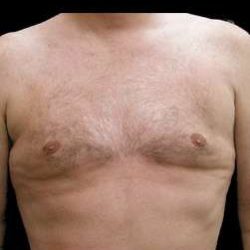 Liposuction and Gynecomastia Before & After Patient #775