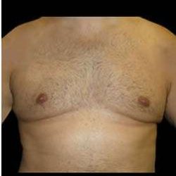 Liposuction and Gynecomastia Before & After Patient #786