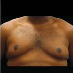 Liposuction and Gynecomastia Before & After Patient #800