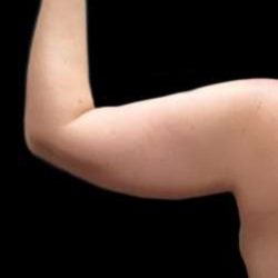 Arm Liposuction Before & After Patient #613