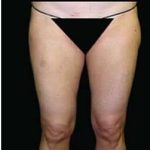 Female Liposuction Before & After Patient #805