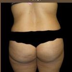 Female Liposuction Before & After Patient #808