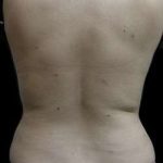 Female Liposuction Before & After Patient #813