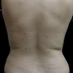 Female Liposuction Before & After Patient #813