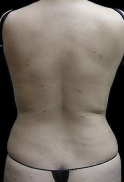 Female Liposuction Before & After Patient #813