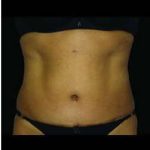 Female Liposuction Before & After Patient #818