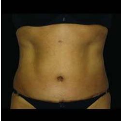 Female Liposuction Before & After Patient #818