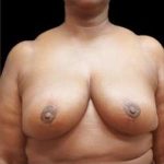 Liposuction and Breast Reduction Before & After Patient #632