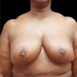 Liposuction and Breast Reduction Before & After Patient #632