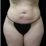 Female Liposuction Before & After Patient #825