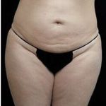 Female Liposuction Before & After Patient #834