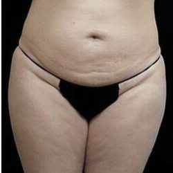 Female Liposuction Before & After Patient #834