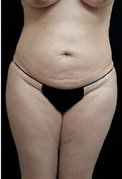 Female Liposuction Before & After Patient #834
