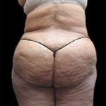Female Liposuction Before & After Patient #855