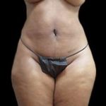 Female Liposuction Before & After Patient #858